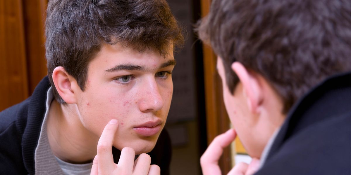 Acné en la adolescencia